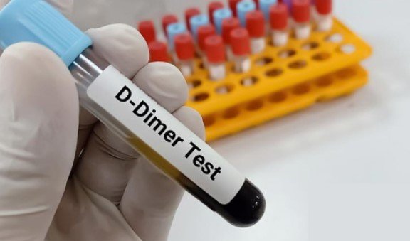 D-dimer test